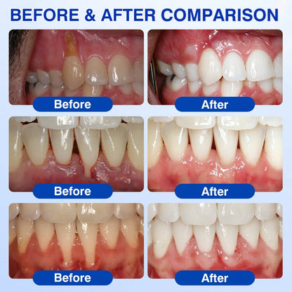 🇺🇸🏆🦷✨GINGEVION™ GumRevive Periodontal Repair Gel
